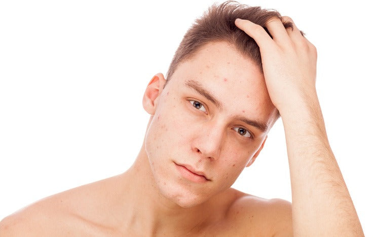 unhappy man observes acne on his face