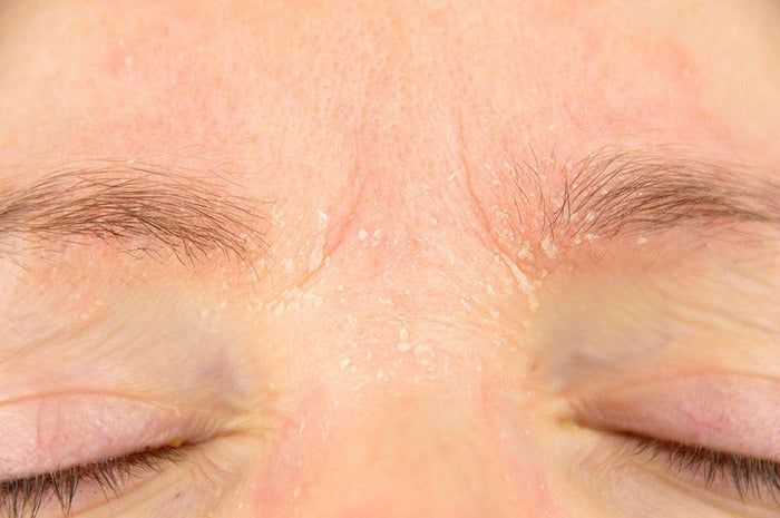 close up of eczema on woman's wrinkled brow